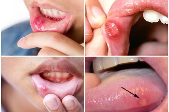 10 bài thuốc dân gian trị viêm loét miệng