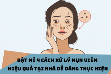 4 cách trị mụn viêm hiệu quả, an toàn dễ thực hiện tại nhà
