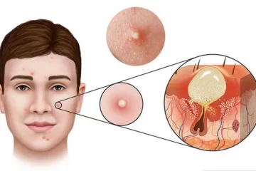 Có nên tự nặn mụn ở nhà không? Tại sao?